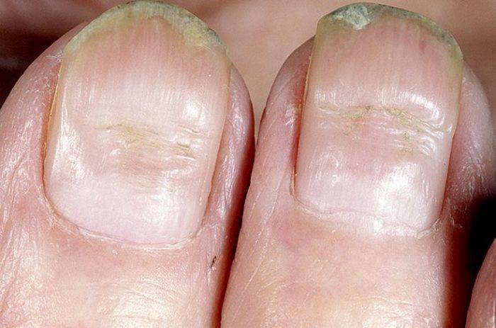 Псориаз ногтей: фото, симптомы на руках и ногах, лечение