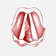 Папиллома в горле: симптомы, типы и опасность заболевания