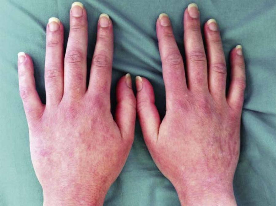 Заболевания кожи рук: дерматит, экзема, симптомы, лечение, фото