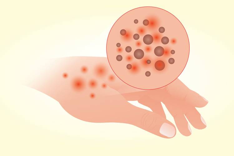 Зудящий дерматит: лечение, симптомы и причины