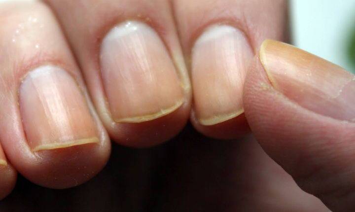 Белые ногти на ногах и руках: почему они меняют цвет, что это значит, какие могут быть причины, кроме болезни, как решить проблему?