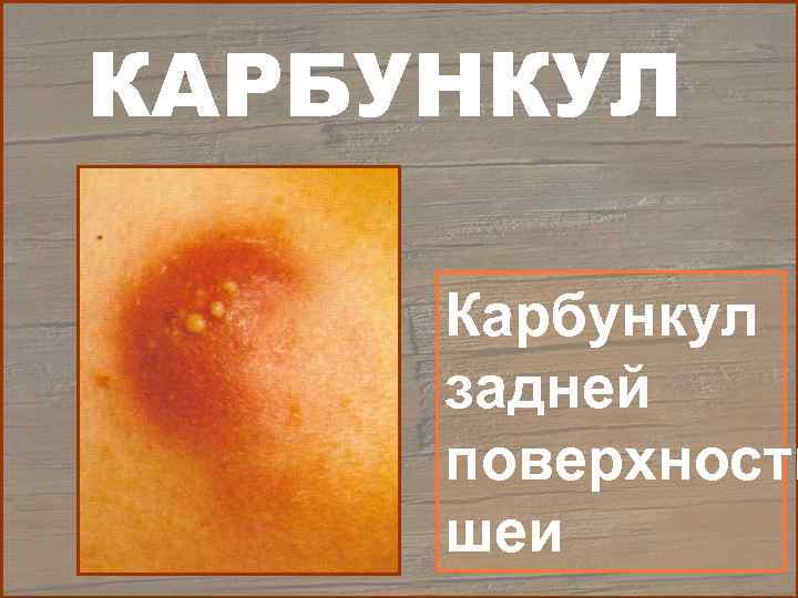 Фурункул на шее: причины появления и чем лечить чирей | mfarma.ru