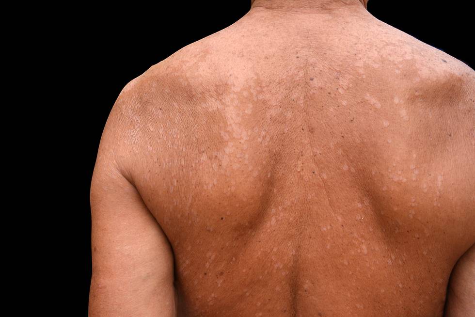 Отрубевидный лишай у человека: симптомы, признаки, как выглядит на теле у людей (фото)