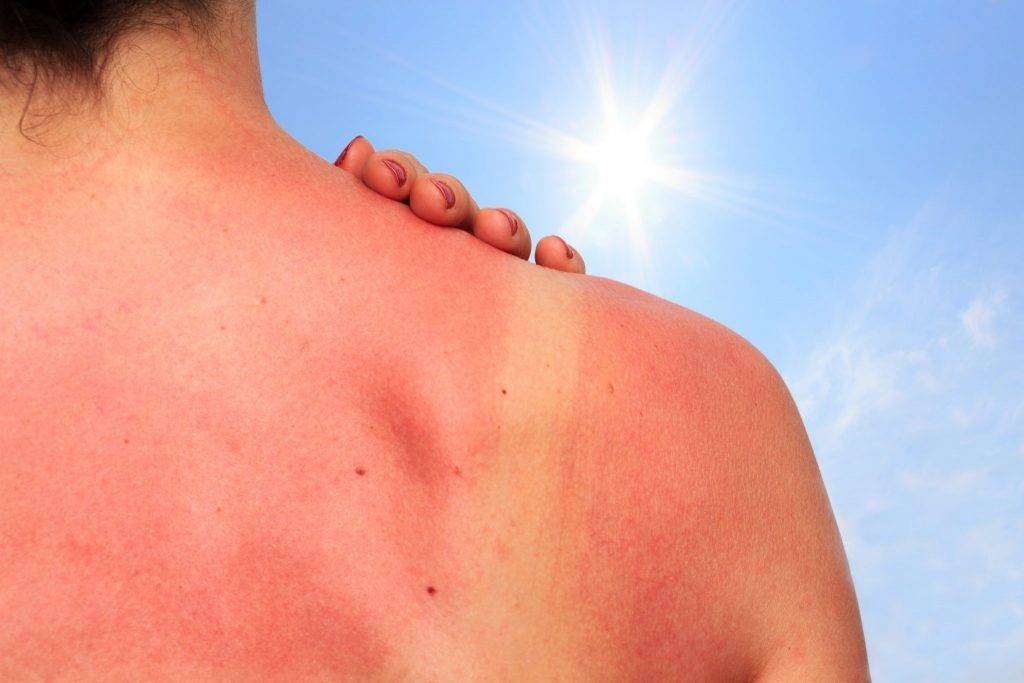 Солнечный дерматит - лечение и фото у взрослых, а также помогают ли мази