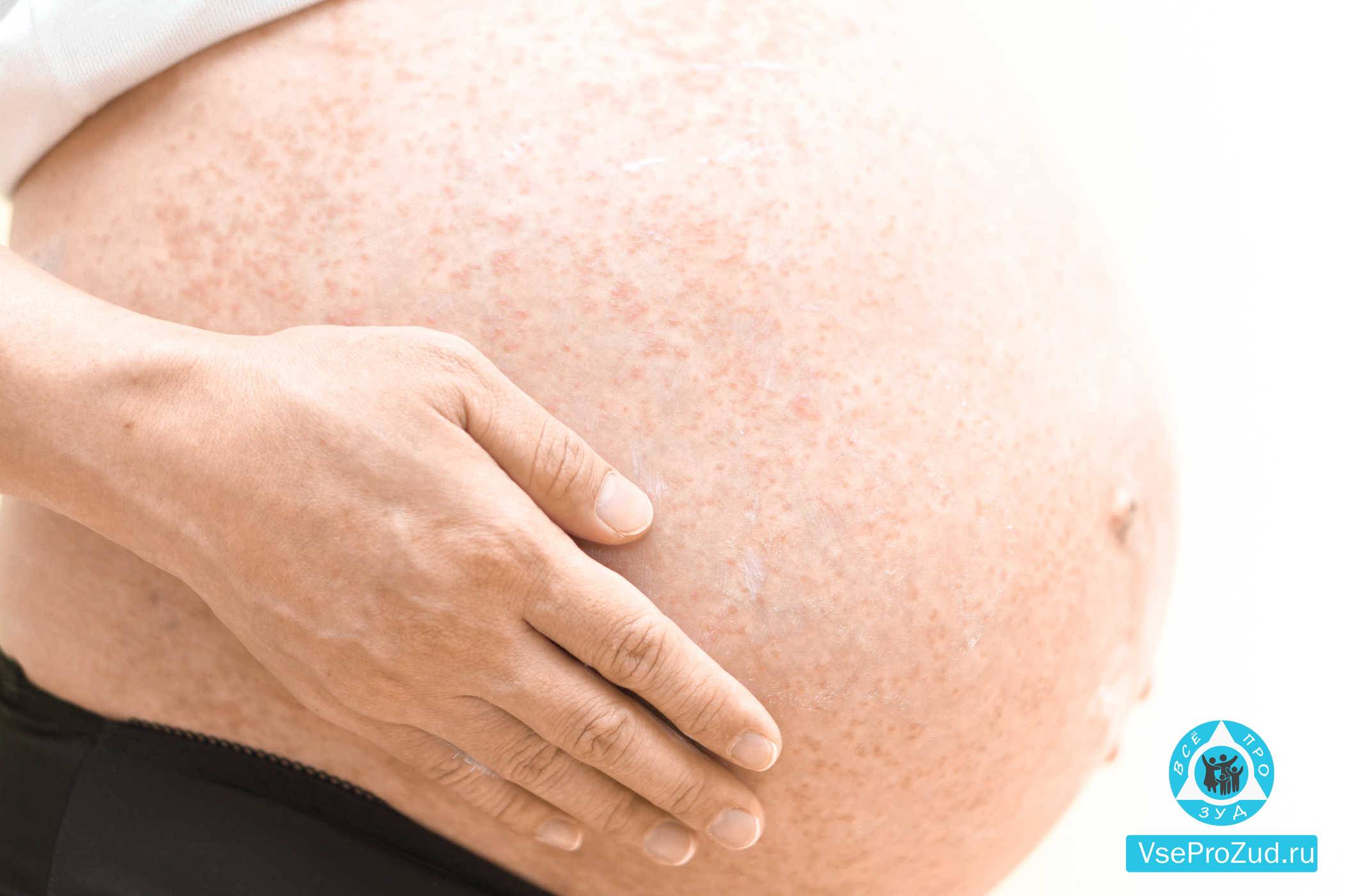 Крапивница при беременности: фото, симптомы, влияние на плод и лечение | fr-dc.ru