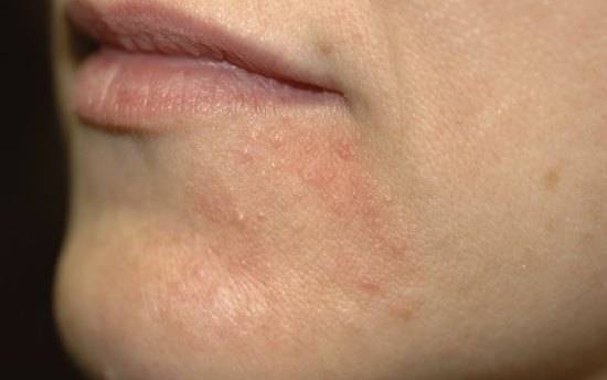 Периоральный (пероральный) дерматит на лице: причины и лечение мазями и другими препаратами, народные средства, фото