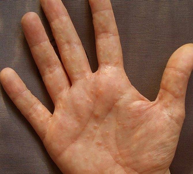 Сухая экзема на руках и пальцах: симптомы, причины возникновения, лечение и профилактика