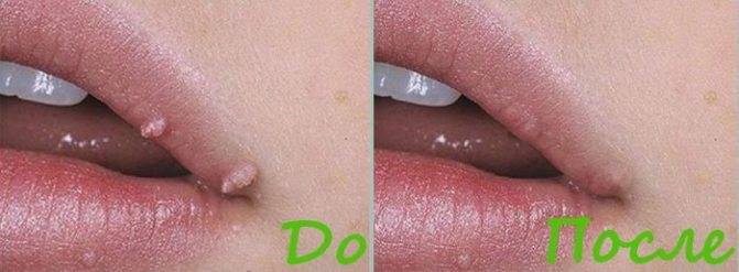 Как предотвратить появление папилломы во рту