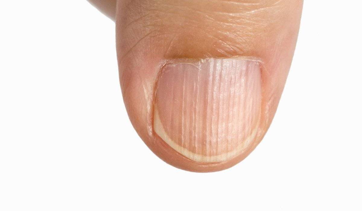 Диагностика по ногтям – распознаем болезни по ногтевой пластине.