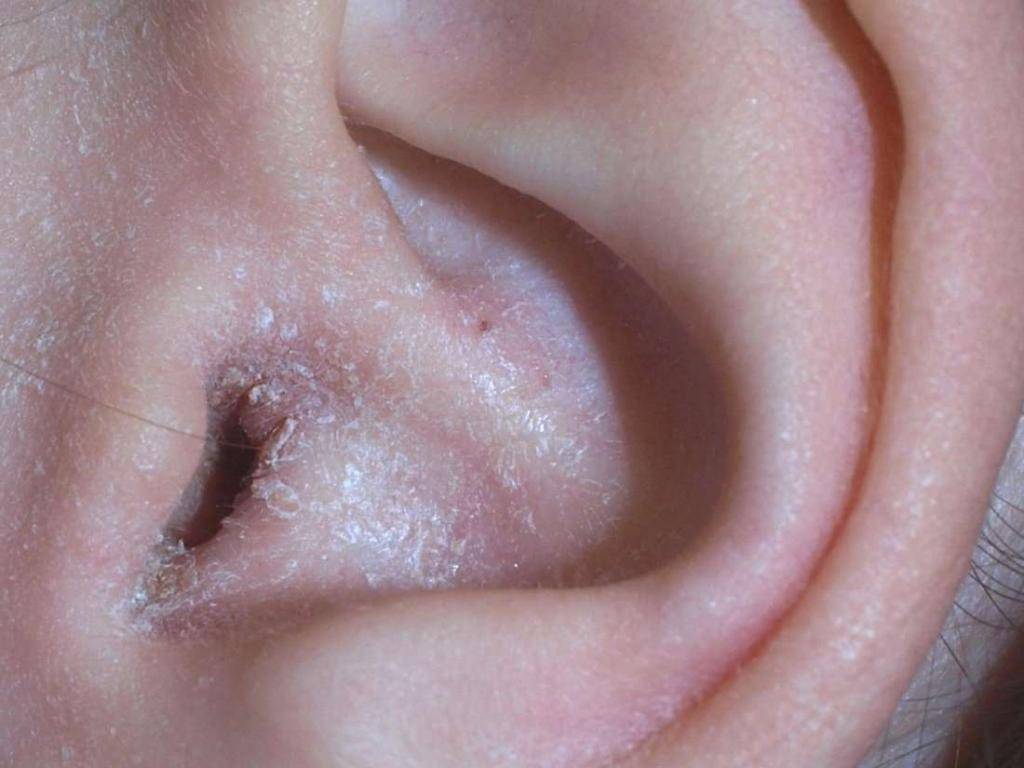 В ухе постоянно образуется корка белая. почему возникает перхоть в ушах? причины этого явления и лечение перхоти