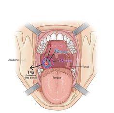 Почему образуется папиллома в горле: симптомы и методы лечения