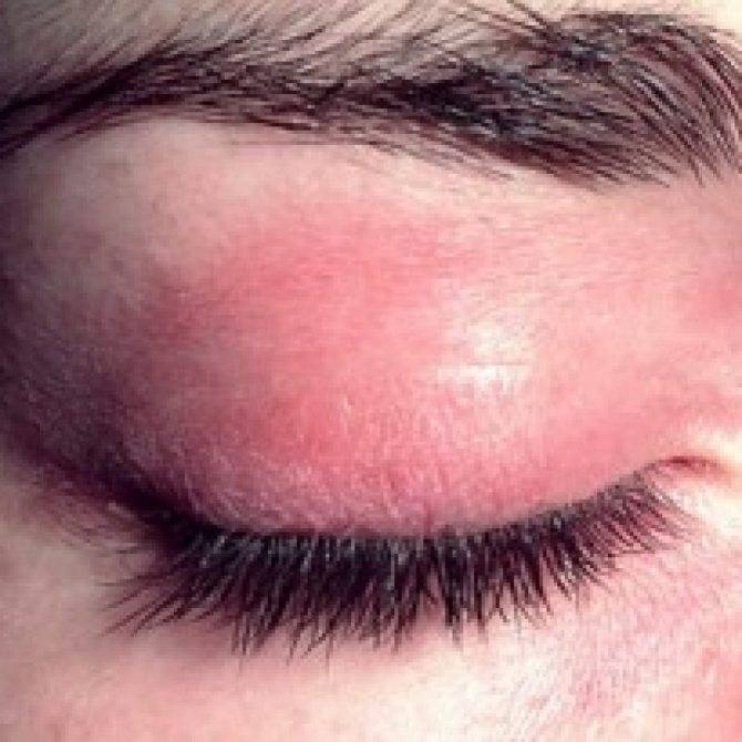 Псориаз на глазах и веках: стадии, симптомы, причины и лечение