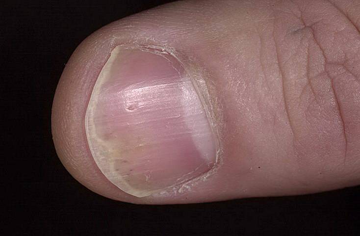 Псориаз ногтей: причины развития заболевания на ногах и руках, способы лечения псориатической ониходистрофии
