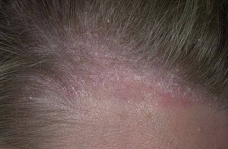 Псориаз головы: начальная стадия, фото высыпаний на волосистой части