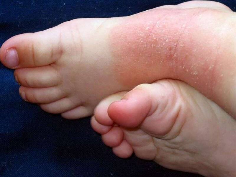 Псориаз ногтей на руках и ногах: причины, диагностика и симптомы с фото