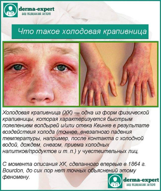 Пигментная крапивница — мастоцитоз: фото, причины и лечение у взрослых и детей | fr-dc.ru