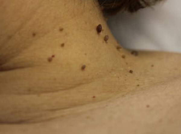 Опасна ли папиллома на спине: причины появления и лечение