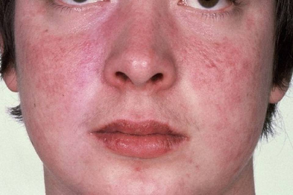 Себорейный дерматит: симптомы себореи и их фото, методы лечения дерматита на коже головы у ребёнка