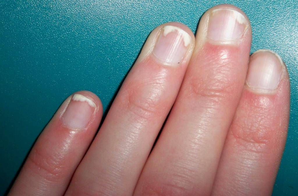 Почему появляются белые полоски на ногтях и что с этим делать