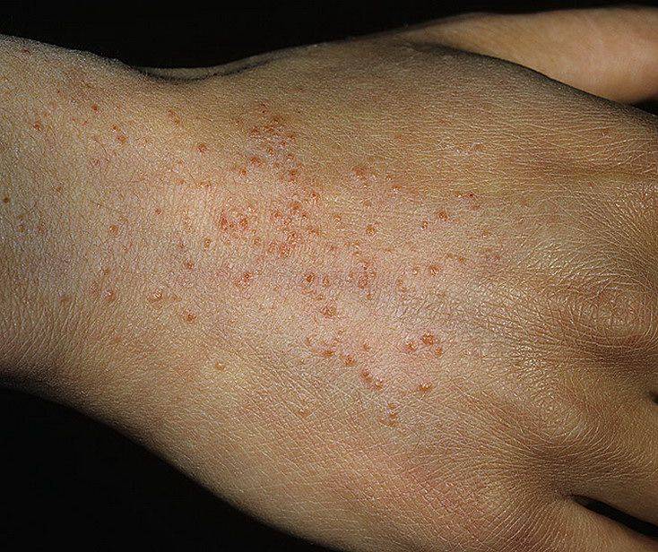 Симптомы и лечение буллезного дерматита