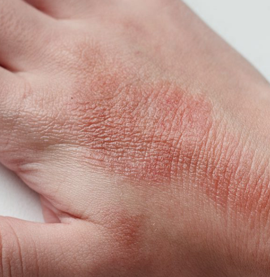 Экзема на руках: можно ли вылечить дерматологическое заболевание?