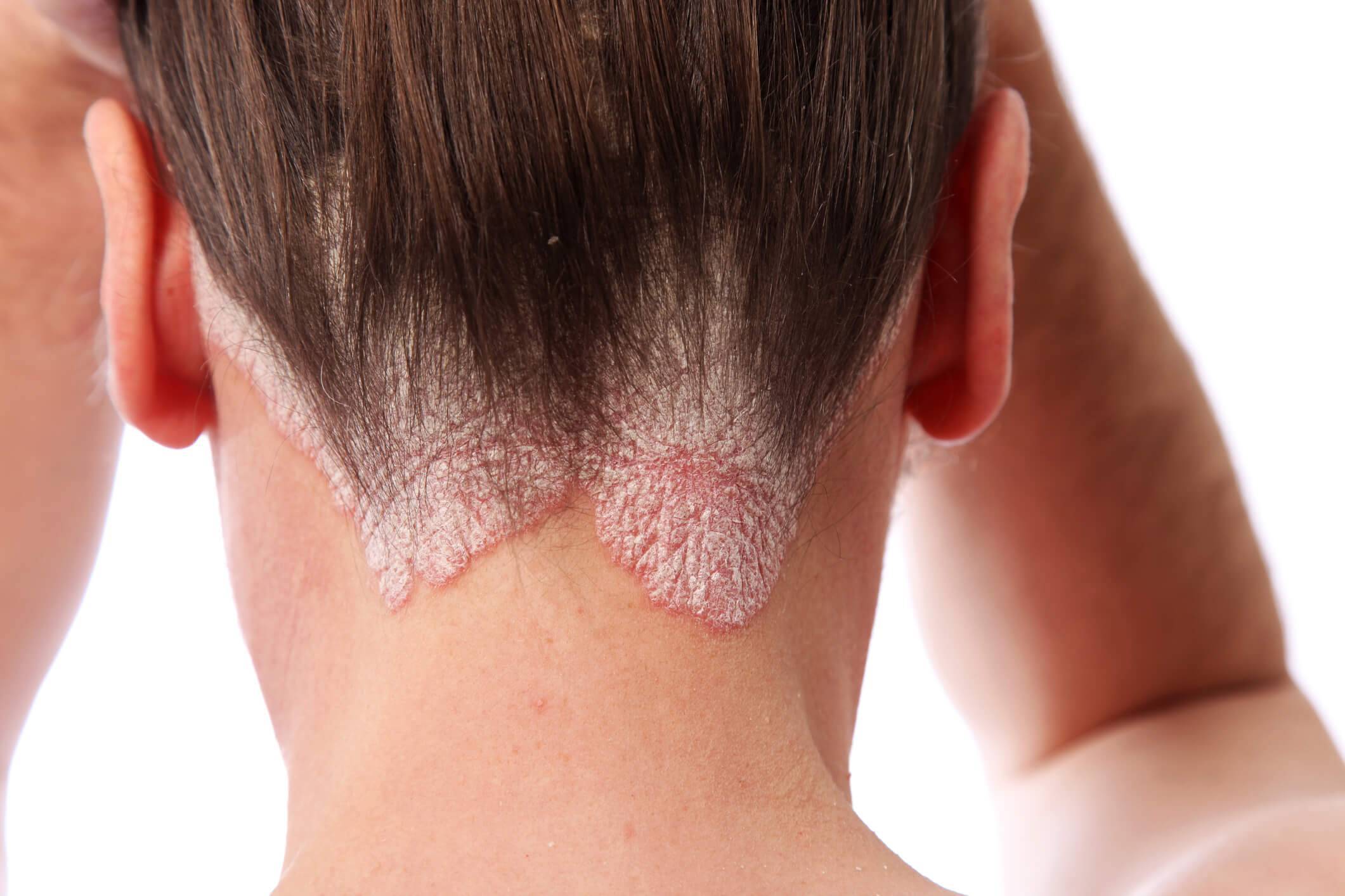 Как лечить псориаз на голове, фото начальной стадии волосистой части, симптомы и лечение в домашних условиях