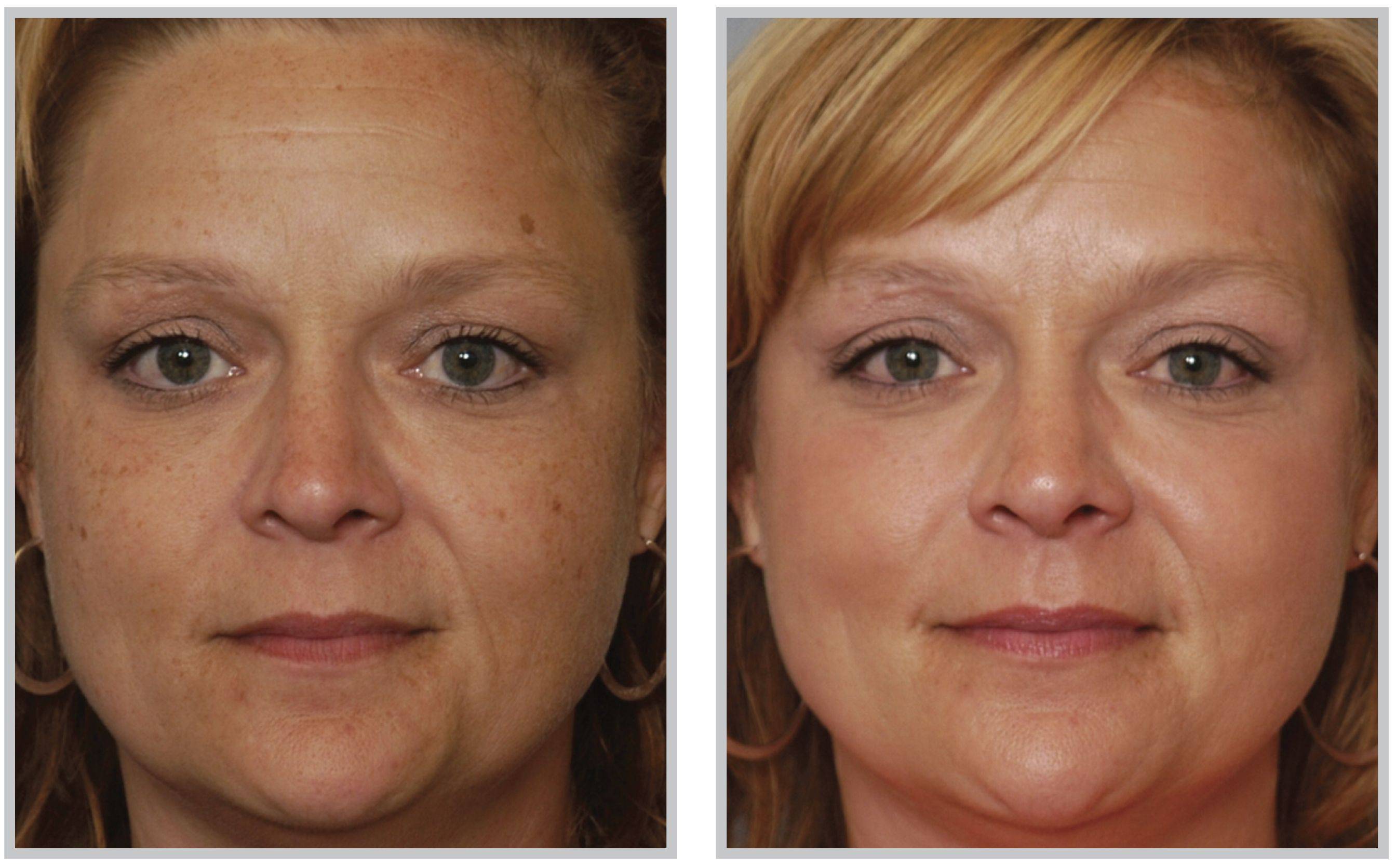 Фотоомоложение кожи лица. фото до и после