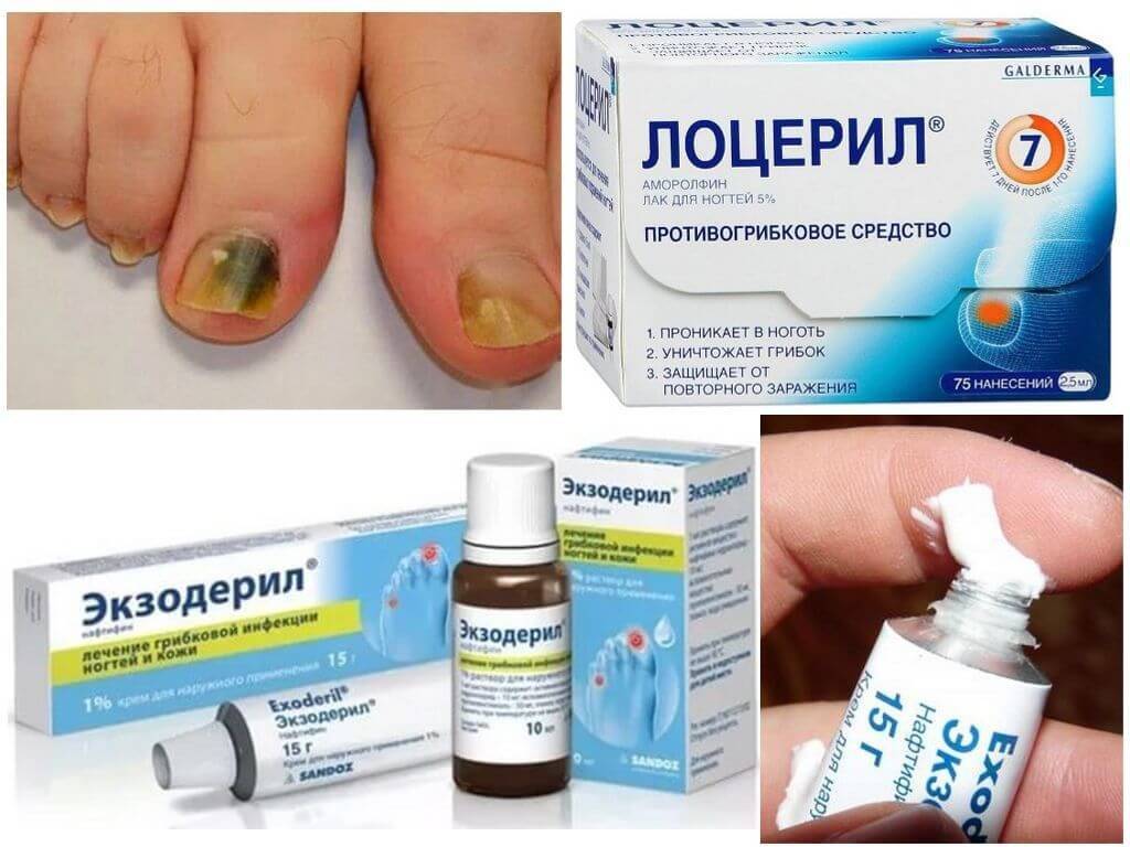 Топ-5 недорогих и эффективных лаков от грибка ногтей