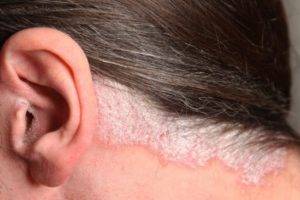 Чем лечить псориаз в ушах (за ушами): фото, симптомы и лечение