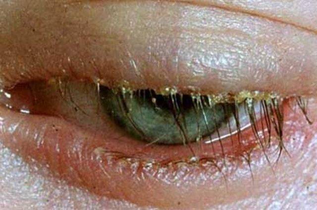 Фото и лечение псориаза на глазах и лице