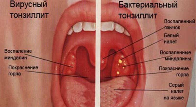 В горле папиллома – лечение папилломы в гортани