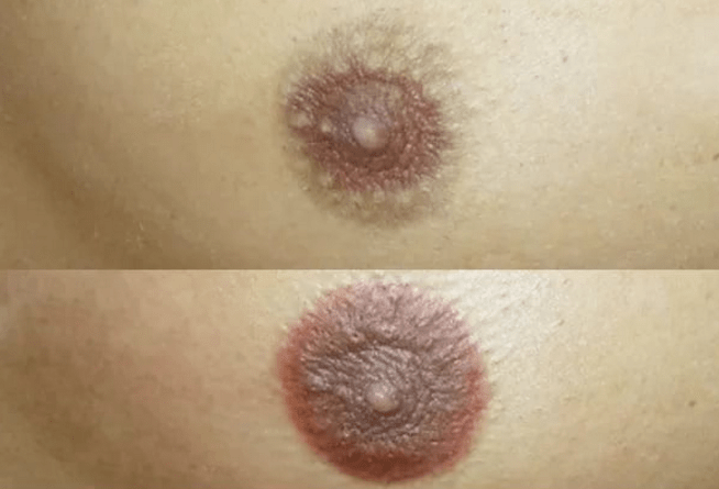 Папилломы под грудью - механизм развития вируса, методы лечения