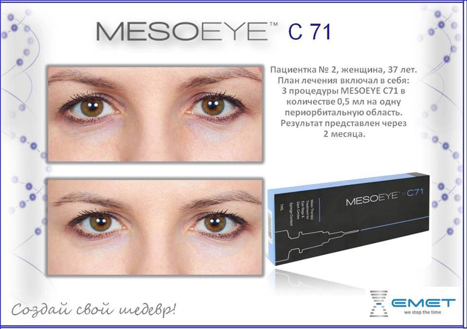 Мезоай (mesoeye): отзывы косметологов и клиентов, кто делал о препарате с 71, фото до и после, цена, состав, эффективность процедуры от мешков и для кожи вокруг глаз, осложнения, противопоказания, результаты