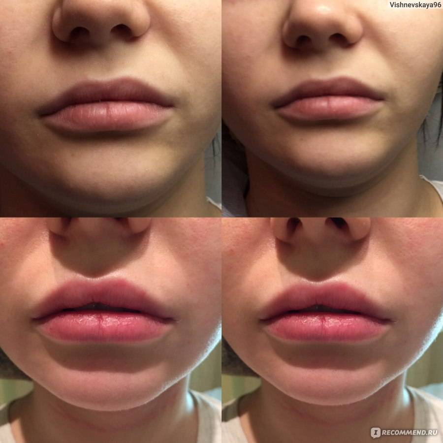Увеличение губ гиалуроновой кислотой — особенности процедуры о которых важно знать