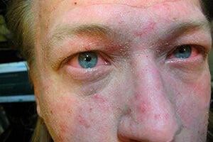 Особенности псориаза на лице: причины возникновения, признаки и методы лечения