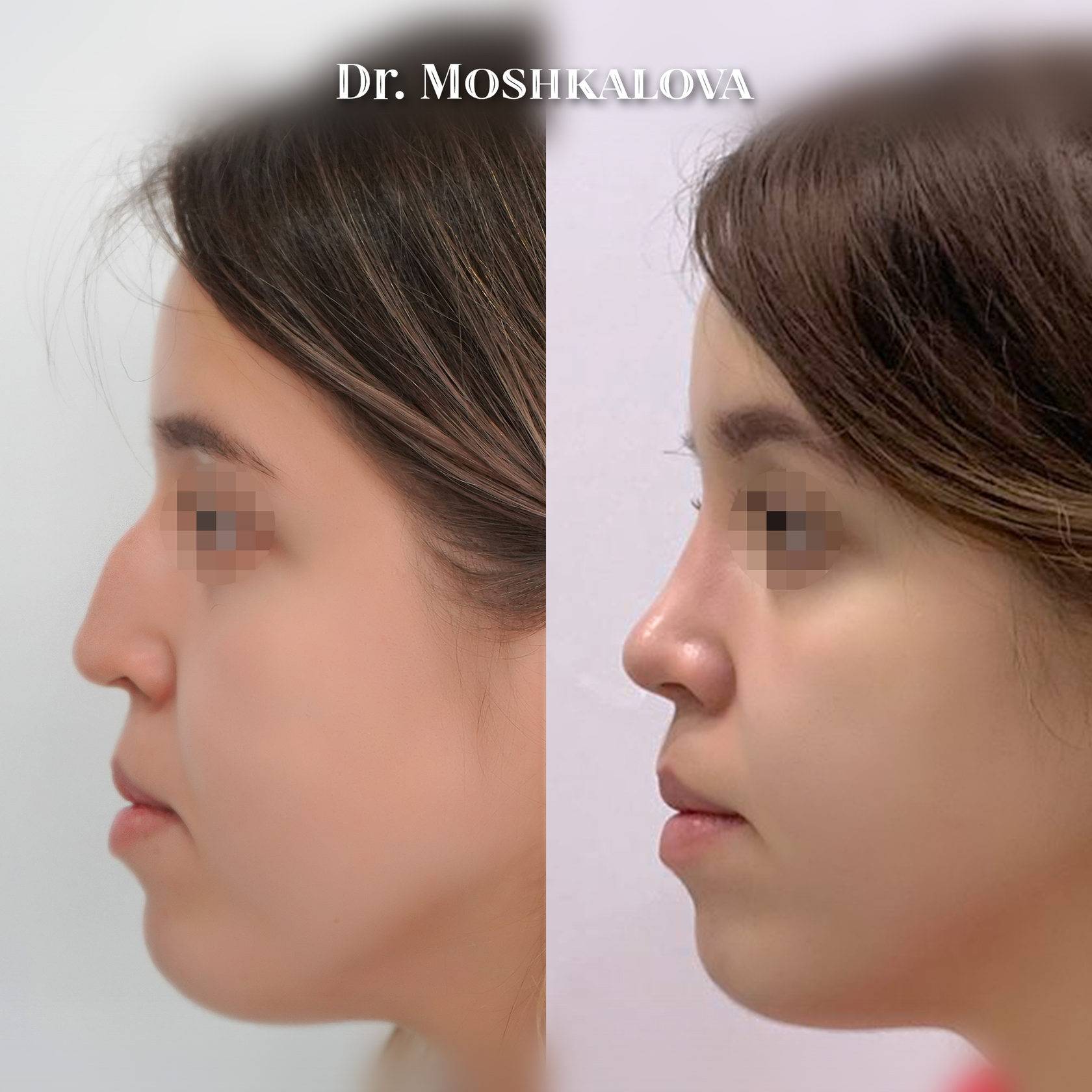 Мужская ринопластика носа - цены, отзывы, фото до и после | ринопластика носа