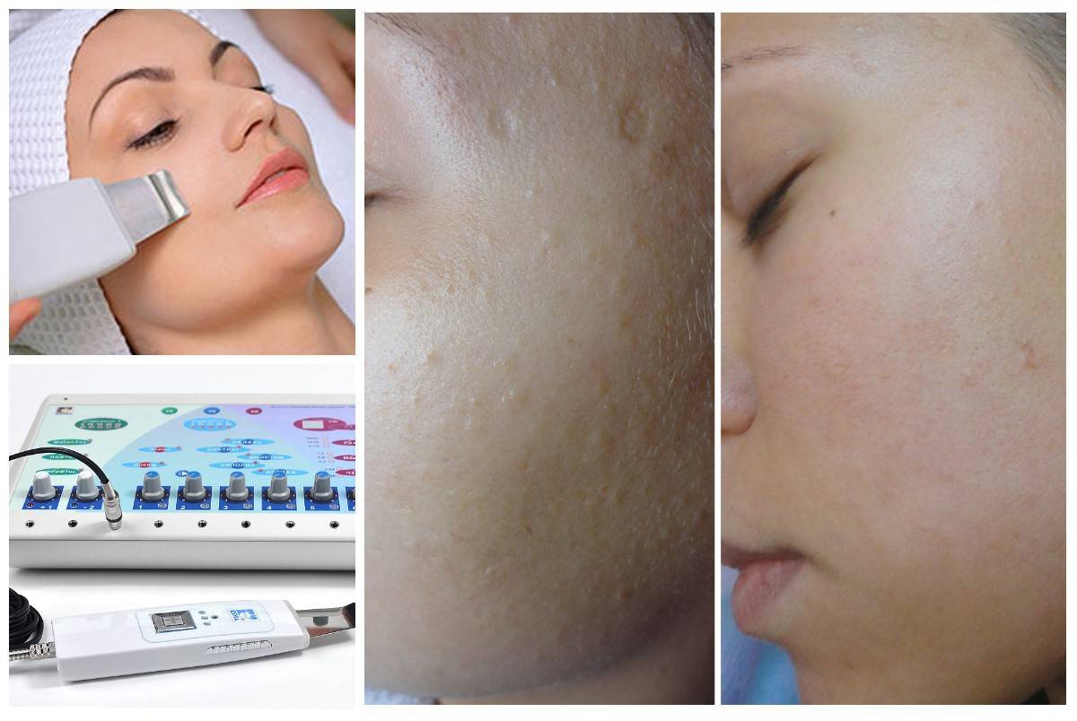 Ультразвуковая чистка лица: фото до и после, отзывы пациентов - idealplastic.ru