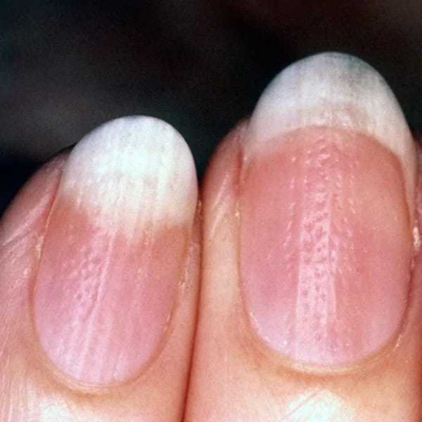 Причины появления белых полосок на ногтях