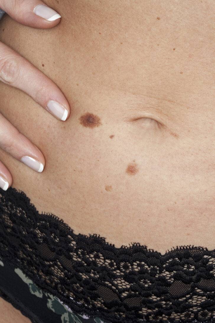 Причины появления папилломы под грудью и как избавиться