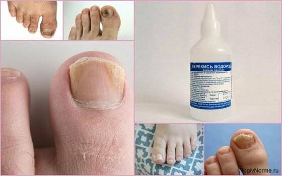 Перекись водорода от грибка ногтей на ногах – отзывы и лечение