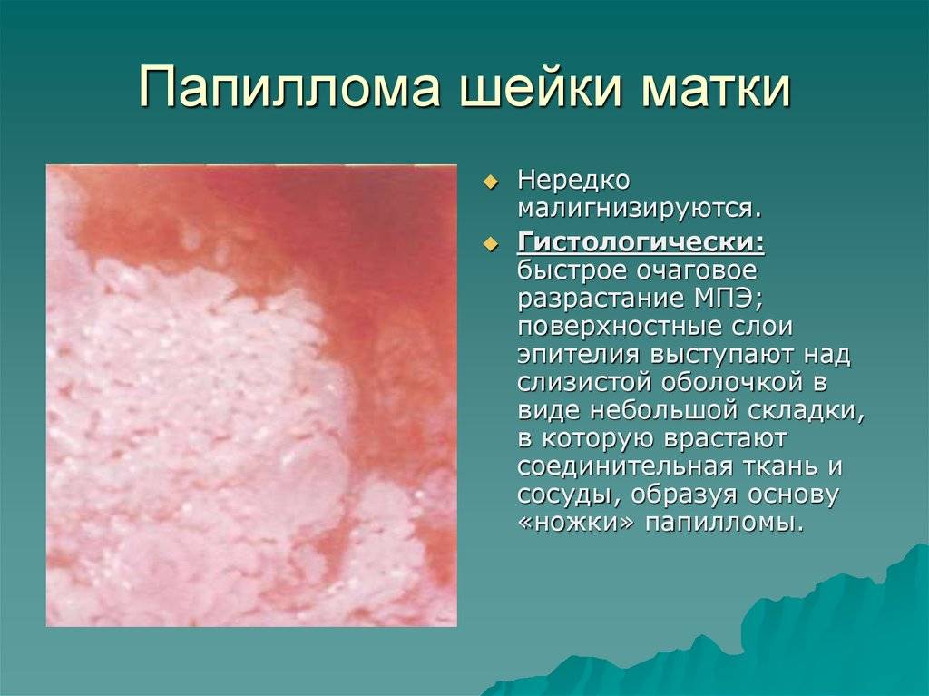 Вирус папилломы человека (впч) на матке, профилактика и причины