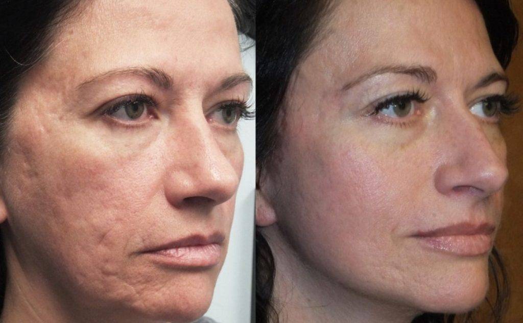 Фотоомоложение кожи лица. фото женщин до и после