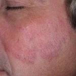 Псориаз на лице: как и чем лечить симптомы и причину появления болезни. 110 фото псориаза и выбор метода его лечения