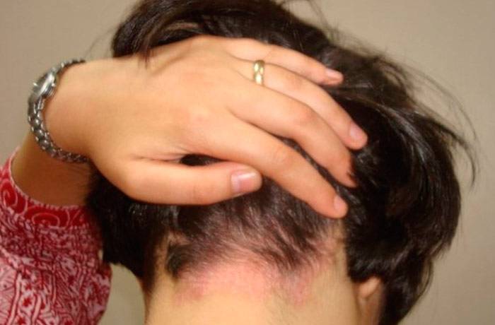 Псориаз на голове: причины, симптомы, лечение народными способами