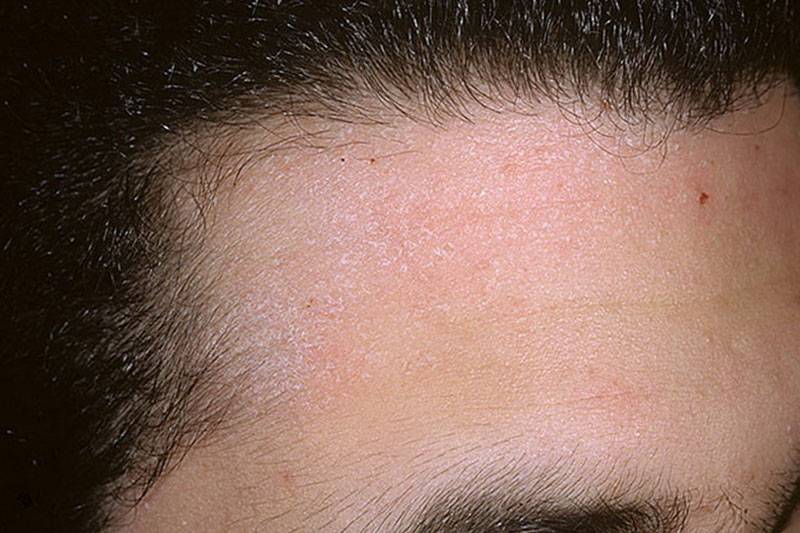Перхоть, себорея и себорейный дерматит волосистой части головы, лица и туловища. причины и признаки. фото. видео
