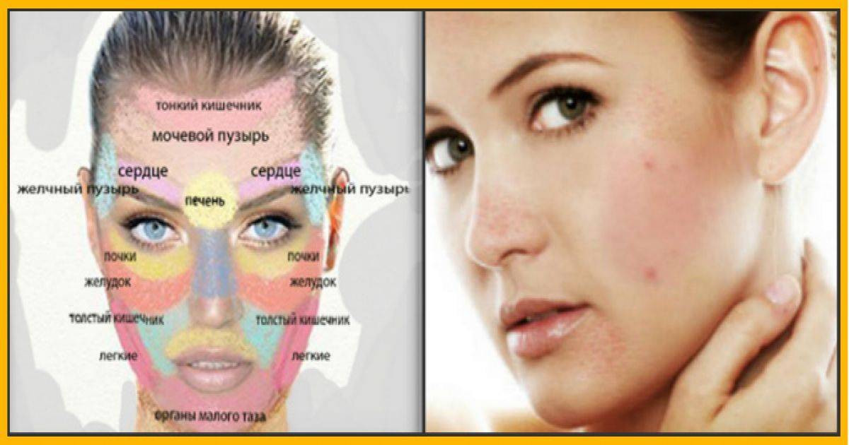 Прыщи на щеках у женщин: причина и лечение глубоких акне на правой и левой щеке
прыщи на щеках у женщин: причина и лечение глубоких акне на правой и левой щеке