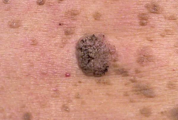 17 причин плоскоклеточной папилломы кожи: что это такое и как лечить