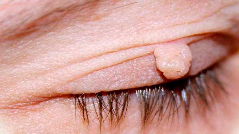 Папилломы на половых губах: причины, лечение, симптомы