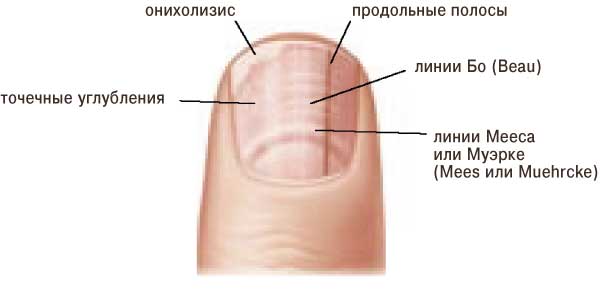 Причины появления  продольных и поперечных полос и точек на ногтях, способы лечения и профилактика