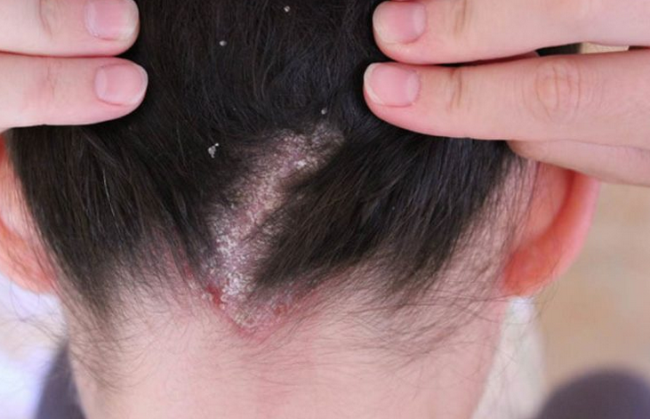 Псориаз на голове - 95 фото заболевания, какой врач это лечит и советы как восстановить кожу и волосы